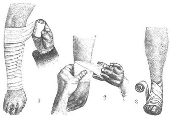 Fig. 1. Einwicklung des Armes. Umschlag der Binde. 3. Achtertour um ein Gelenk.
